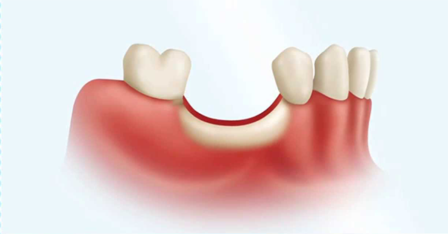 bone graft